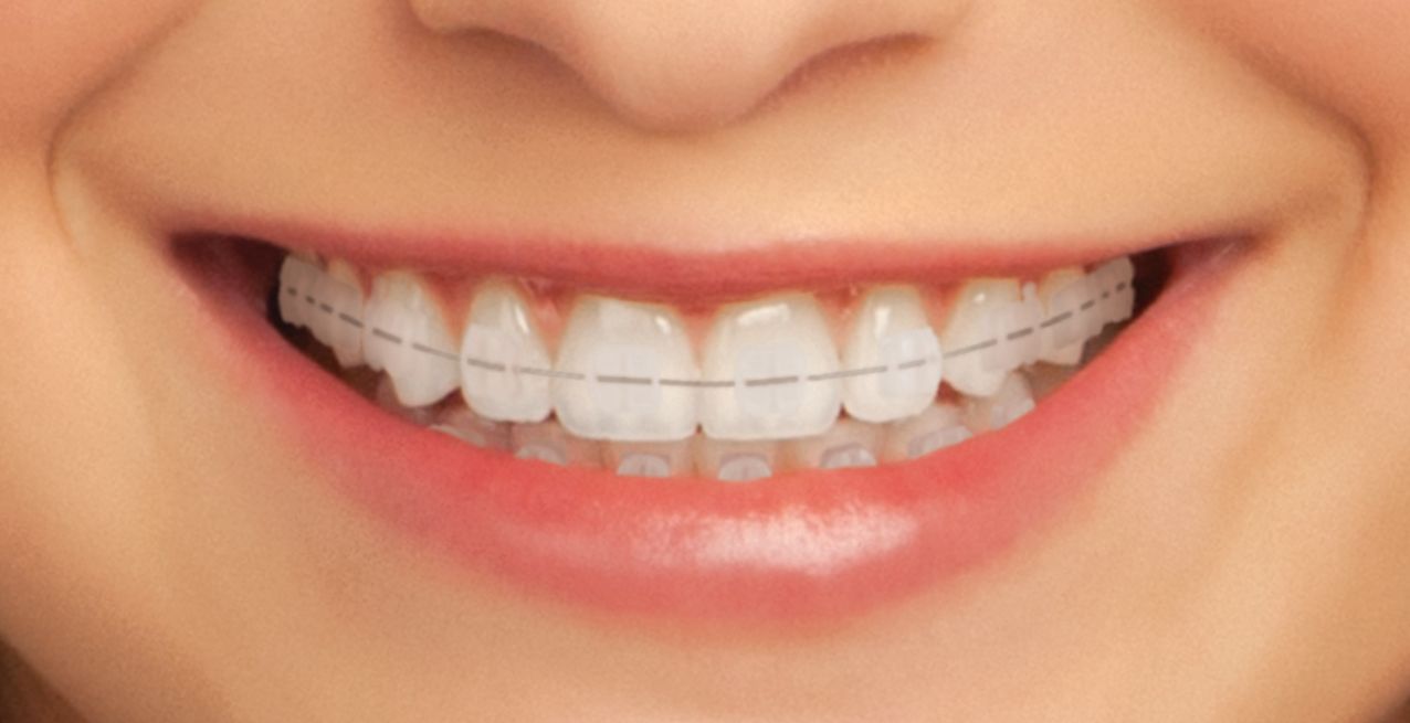 Types of Braces